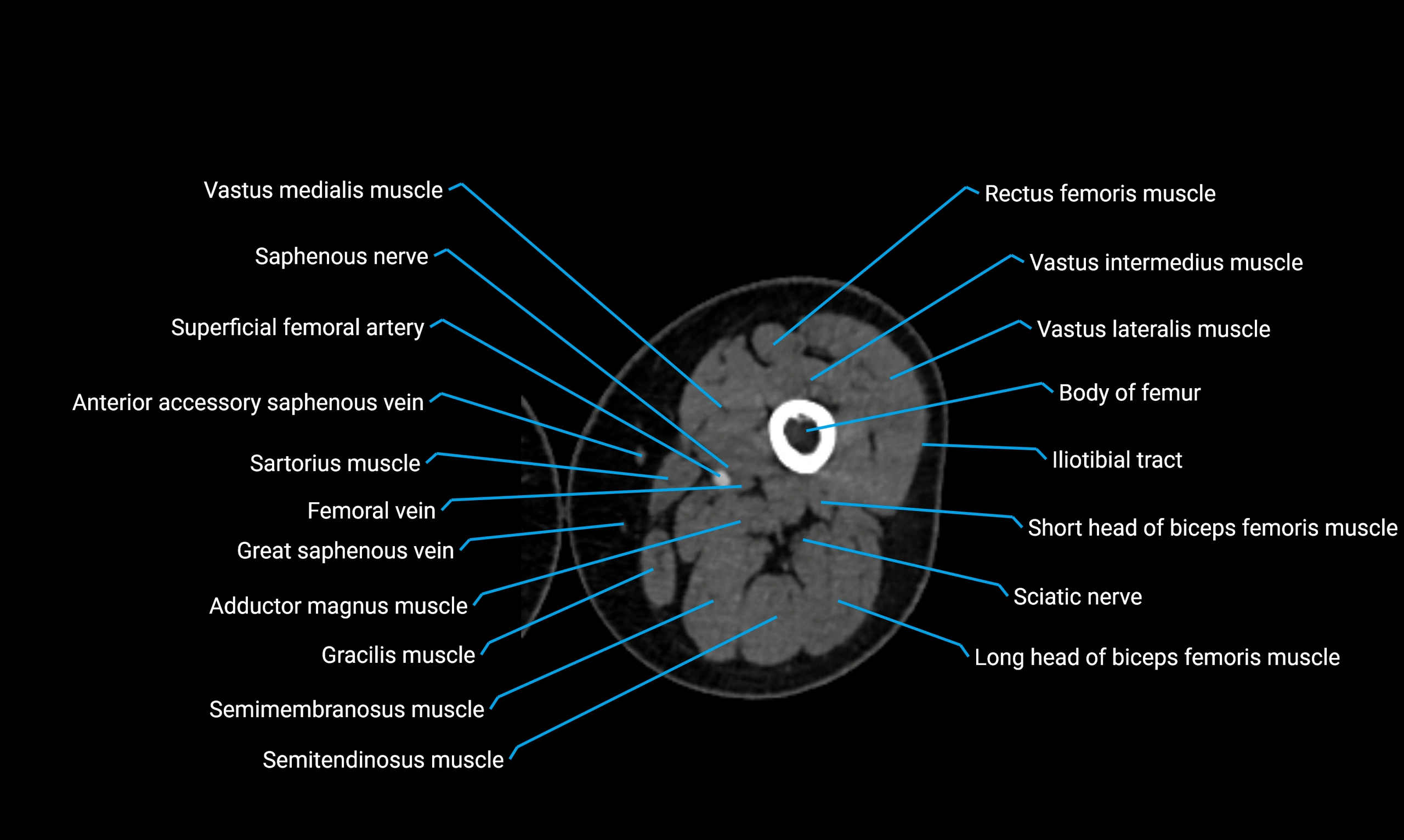 CT thigh axial cross sectional anatomy labelled image_56 (2).webp
